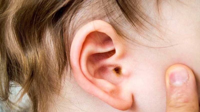 uzmani uyardi orta kulak iltihabi cocuklarda gecici isitme kaybina neden olabilir hAM1SmcZ